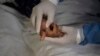 México y Cuba reportan inusuales muertes de dos pacientes con viruela del mono