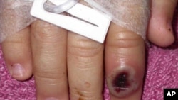 chigunwe chine monkeypox 