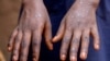 Primeiro caso de Mpox em Angola