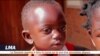 Une ONG opère gratuitement les becs de lièvre au Malawi