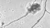 美國真菌性腦膜炎死亡病例達15宗